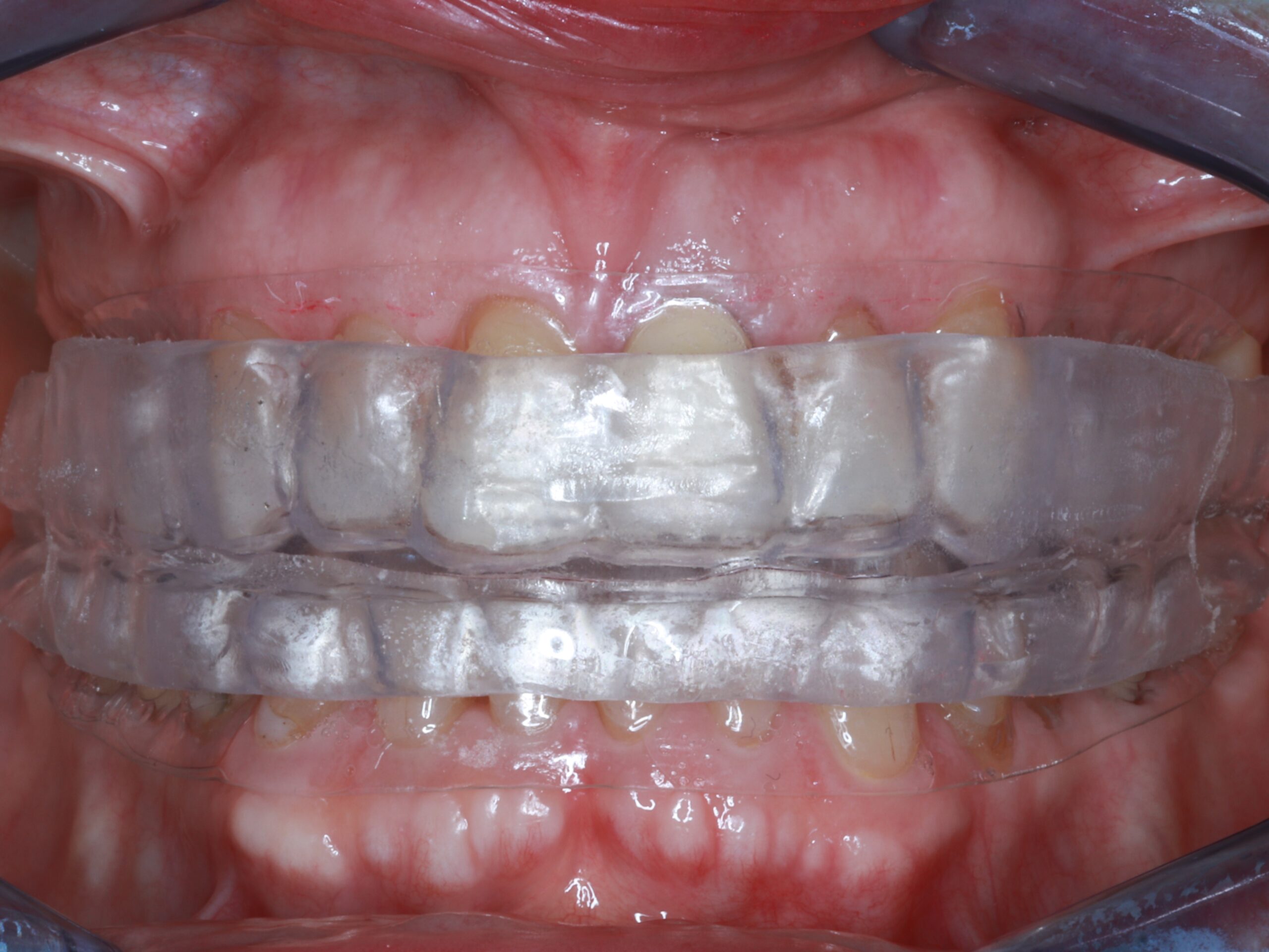 Treat different with aligners Treat Differently With Aligners! The concept set in the creation of SyncSplint makes the new approach to aligner therapy completely possible.