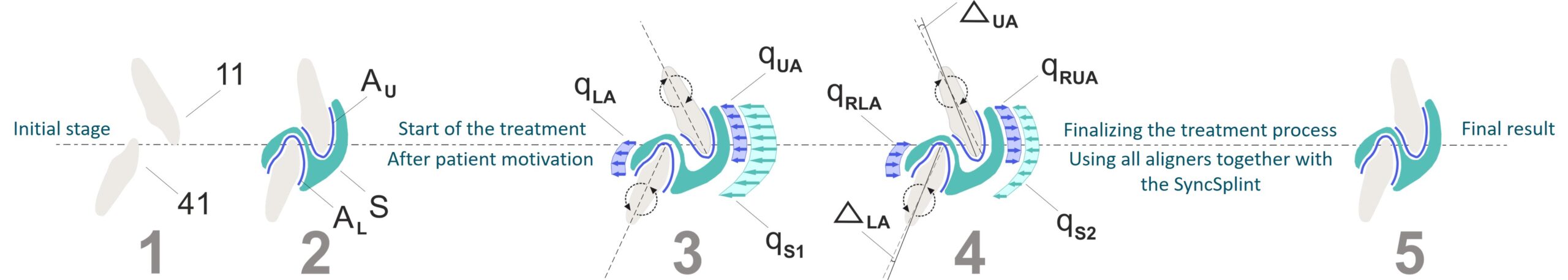 SyncSplint For Aligners forces scheme