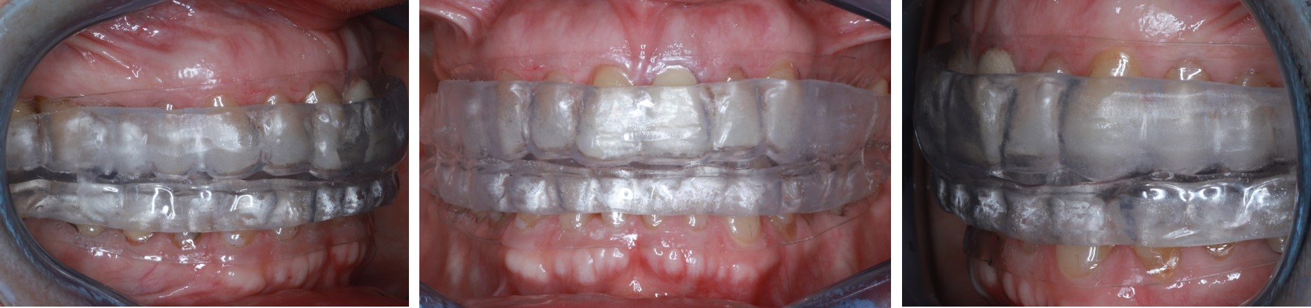 SyncSplint patient