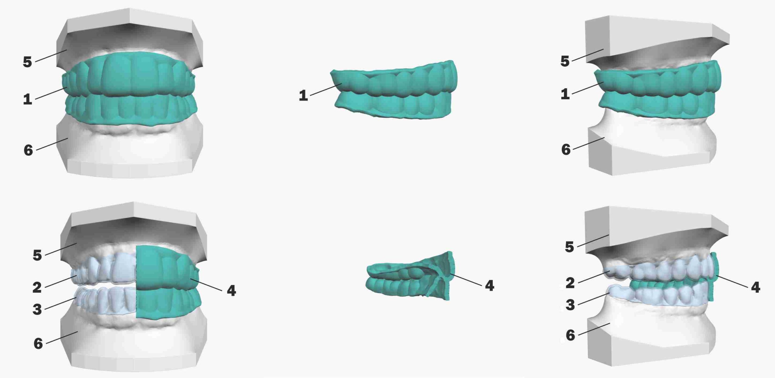 SyncSplint For Aligners patent scheme 07