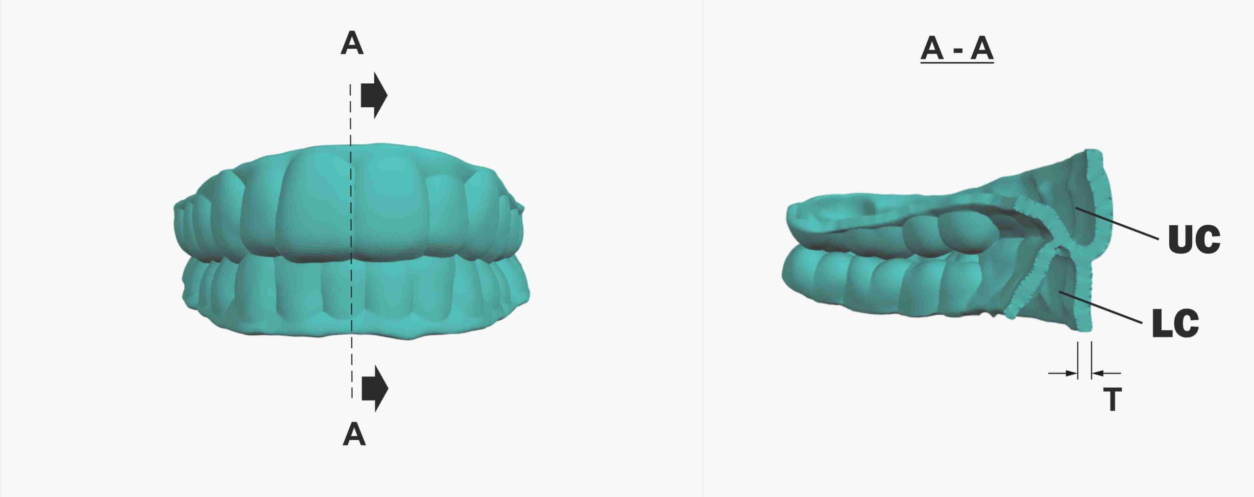 SyncSplint For Aligners patent scheme 05