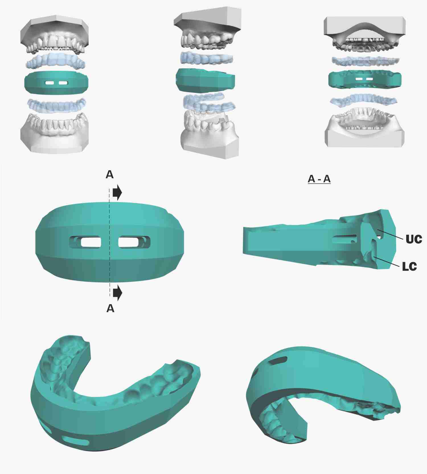 SyncSplint For Aligners patent scheme 01